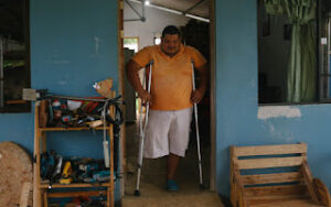 Delvis Castillo perdió su pierna derecha en una de las fincas de Coopepiña, cuando recibió una descarga eléctrica luego de que lo presionaran para que hiciera un trabajo para el que no estaba capacitado. 
